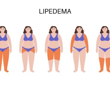 Dolor, hinchazón y dificultad para caminar: así impacta el lipedema en la vida de las mujeres