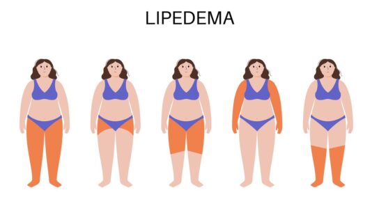 Dolor, hinchazón y dificultad para caminar: así impacta el lipedema en la vida de las mujeres